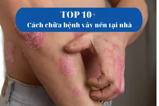 TOP 10+ cách chữa bệnh vảy nến tại nhà mà bạn nên thử